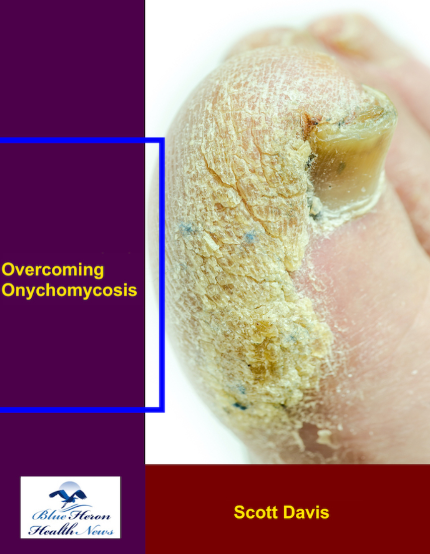 (PDF) Overcoming Onychomycosis Book By Scott Davis